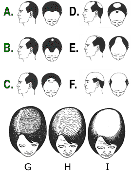 Stages Of Hair Loss In Men & Women 